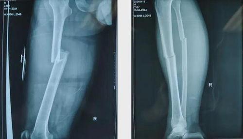 骨折视频,视频揭示骨折发生过程及应对措施